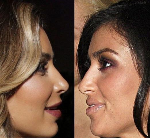 Kim Kardashian: 10 + 1 φωτογραφίες πριν και μετά τις πλαστικές