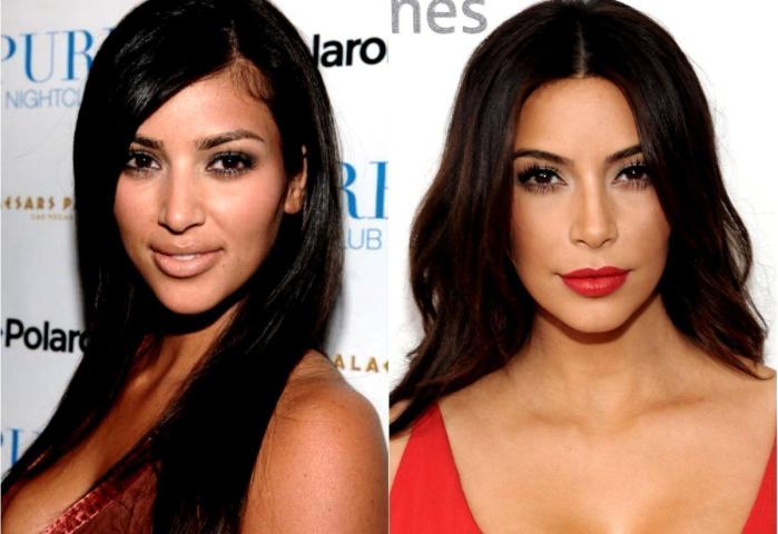 Kim Kardashian: 10 + 1 φωτογραφίες πριν και μετά τις πλαστικές
