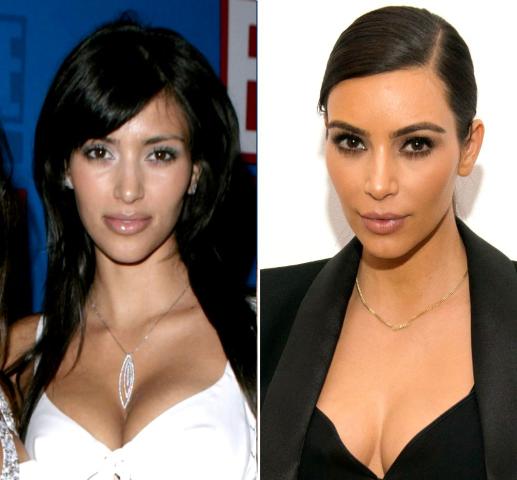 Kim Kardashian: 10 + 1 φωτογραφίες πριν και μετά τις πλαστικές