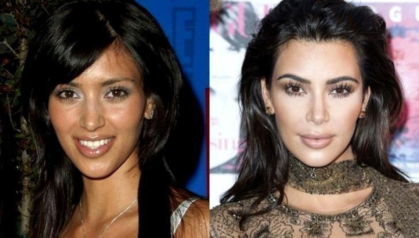 Kim Kardashian: 10 + 1 φωτογραφίες πριν και μετά τις πλαστικές