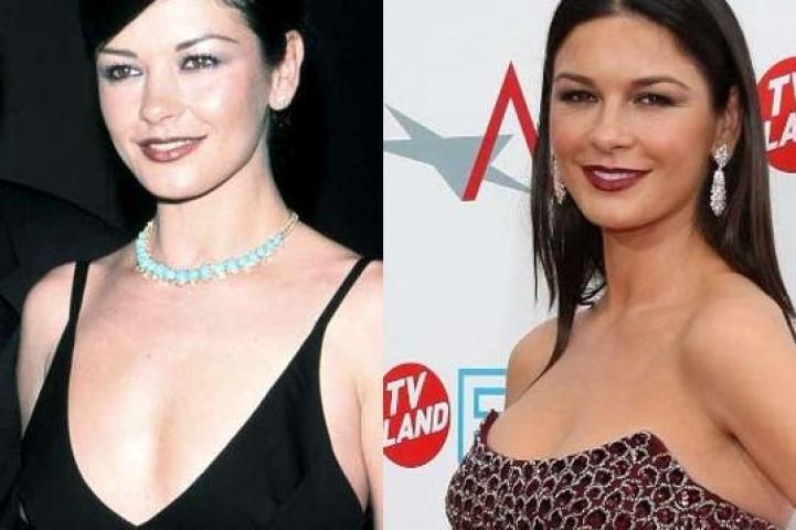 Οι 10 celebrities με τις πιο επιτυχημένες πλαστικές στήθους Οι 10 celebrities με τις πιο επιτυχημένες πλαστικές στήθους
