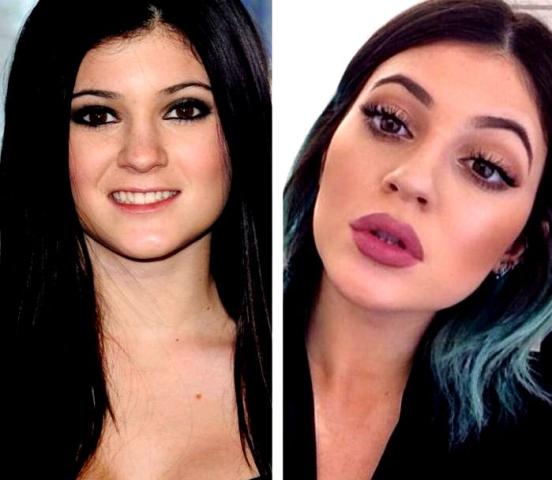 Kylie Jenner: Η ολική «μεταμόρφωση» από τις πλαστικές μέσα από 15 φωτογραφίες 