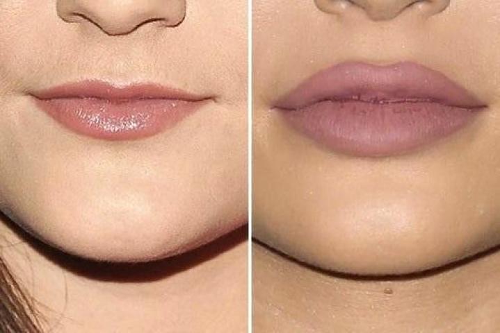 Kylie Jenner: Η ολική «μεταμόρφωση» από τις πλαστικές μέσα από 15 φωτογραφίες 