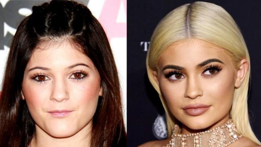 Kylie Jenner: Η ολική «μεταμόρφωση» από τις πλαστικές μέσα από 15 φωτογραφίες 
