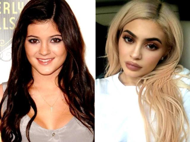 Kylie Jenner: Η ολική «μεταμόρφωση» από τις πλαστικές μέσα από 15 φωτογραφίες 