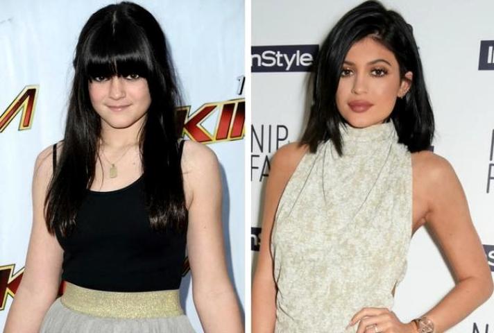 Kylie Jenner: Η ολική «μεταμόρφωση» από τις πλαστικές μέσα από 15 φωτογραφίες 