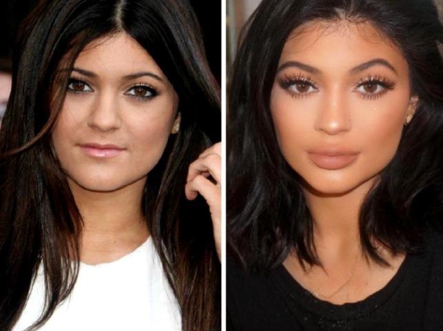 Kylie Jenner: Η ολική «μεταμόρφωση» από τις πλαστικές μέσα από 15 φωτογραφίες 