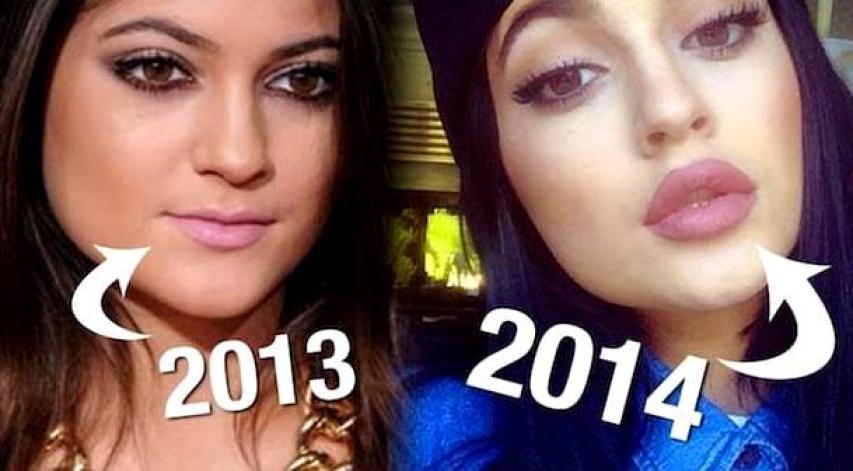 Kylie Jenner: Η ολική «μεταμόρφωση» από τις πλαστικές μέσα από 15 φωτογραφίες 