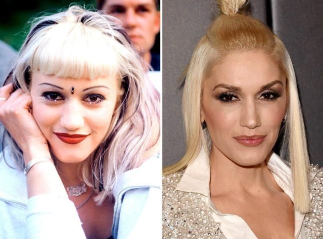 10 celebrities που είπαν «ναι» στην πλαστική μύτης