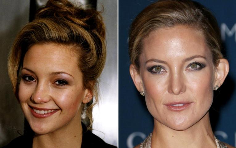 10 celebrities που είπαν «ναι» στην πλαστική μύτης