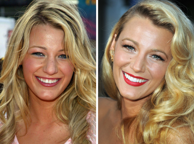 Blake Lively before & after: Η μοναδική πλαστική επέμβαση στην οποία η star έχει πει το «ναι»
