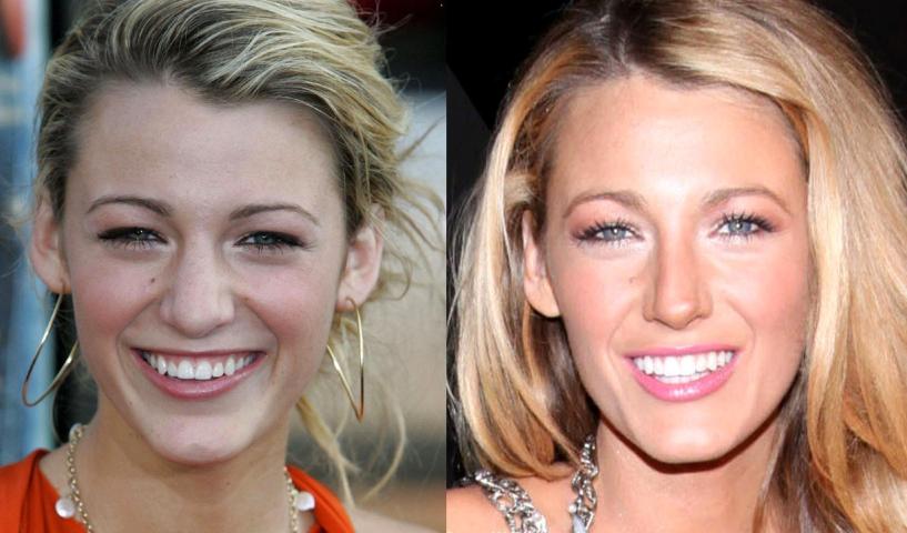 Blake Lively before & after: Η μοναδική πλαστική επέμβαση στην οποία η star έχει πει το «ναι»
