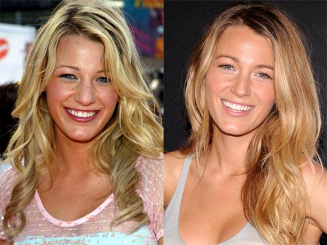 Blake Lively before & after: Η μοναδική πλαστική επέμβαση στην οποία η star έχει πει το «ναι»