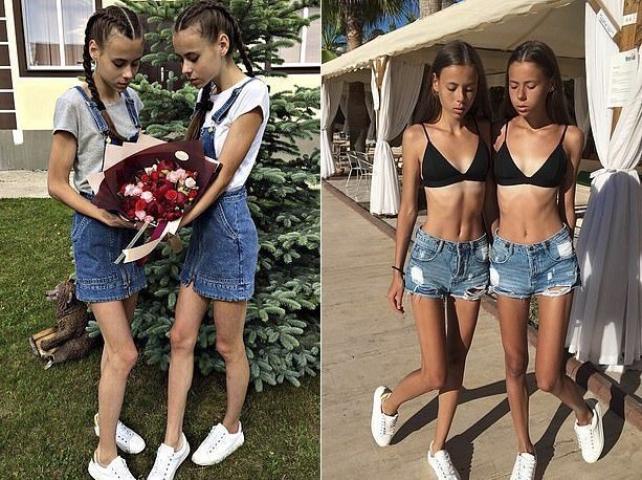 14χρονες δίδυμες κατέληξαν σε κώμα όταν σχολή modeling τις προέτρεψε να χάσουν περισσότερο βάρος 14χρονες δίδυμες κατέληξαν σε κώμα όταν σχολή modeling τις προέτρεψε να χάσουν περισσότερο βάρος