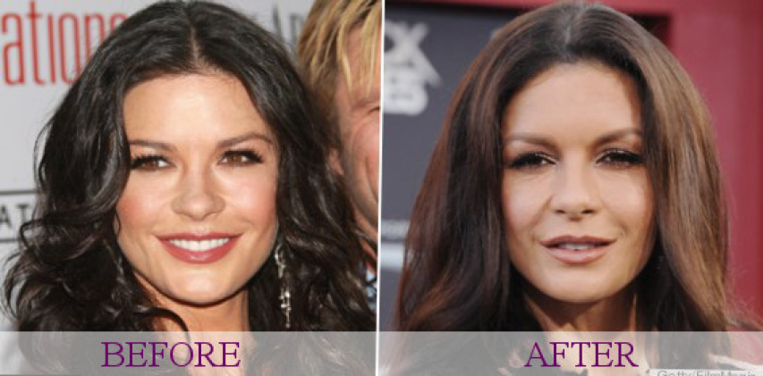 Catherine Zeta-Jones: Μήπως υπερέβαλλε με τις πλαστικές; Catherine Zeta-Jones: Μήπως υπερέβαλλε με τις πλαστικές;