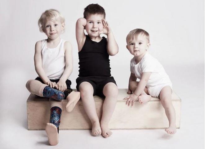 Η εμβληματική φωτογράφιση που αποδεικνύει πως η ομορφιά δεν μετριέται στα σημάδια Η εμβληματική φωτογράφιση που αποδεικνύει πως η ομορφιά δεν μετριέται στα σημάδια