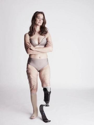 Η εμβληματική φωτογράφιση που αποδεικνύει πως η ομορφιά δεν μετριέται στα σημάδια Η εμβληματική φωτογράφιση που αποδεικνύει πως η ομορφιά δεν μετριέται στα σημάδια